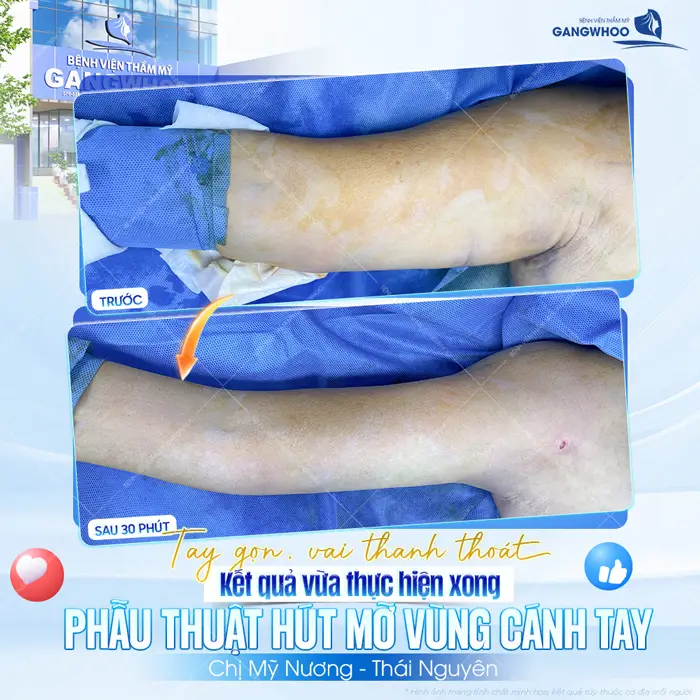 Tay gọn vai thanh thoát kết quả sau phẫu thuật hút mỡ vùng cánh tay đẹp gọn ngay