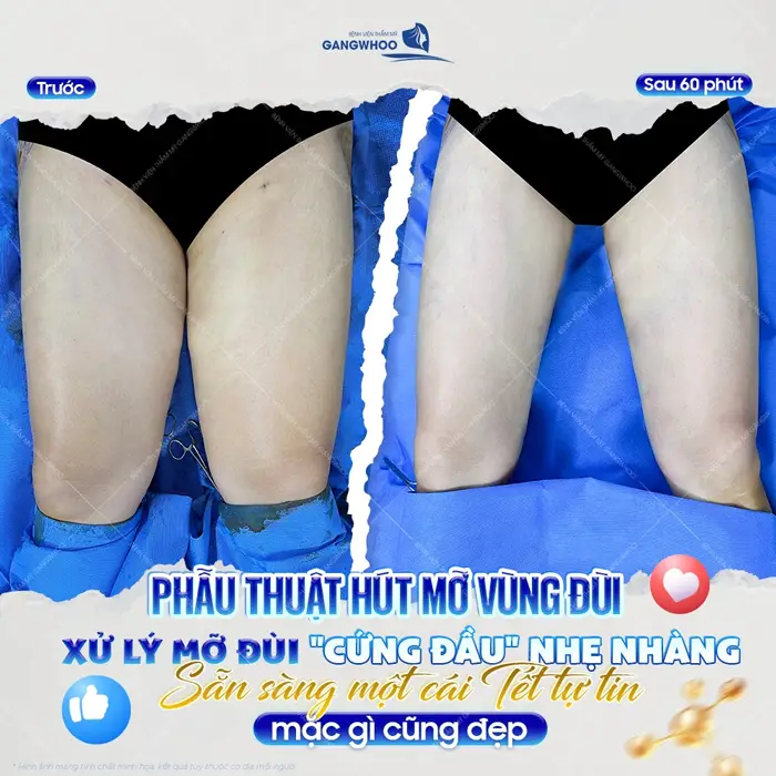 Phẫu thuật hút mỡ vùng đùi xử lý mỡ đùi cứng đầu nhẹ nhàng sẵn sàng 1 cái Tết tự tin 