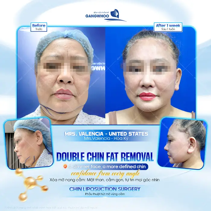 Xóa mỡ nọng cằm, một lần thực hiện cứu cánh cho cả gương mặt đẹp mãi về sau