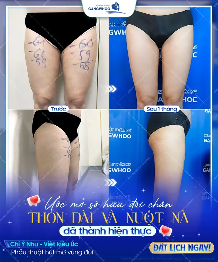Ước mơ sở hữu đôi chân thon dài và nuột nà thành hiện thực sau 1 tháng tái khám đã hoàn toàn thay đổi