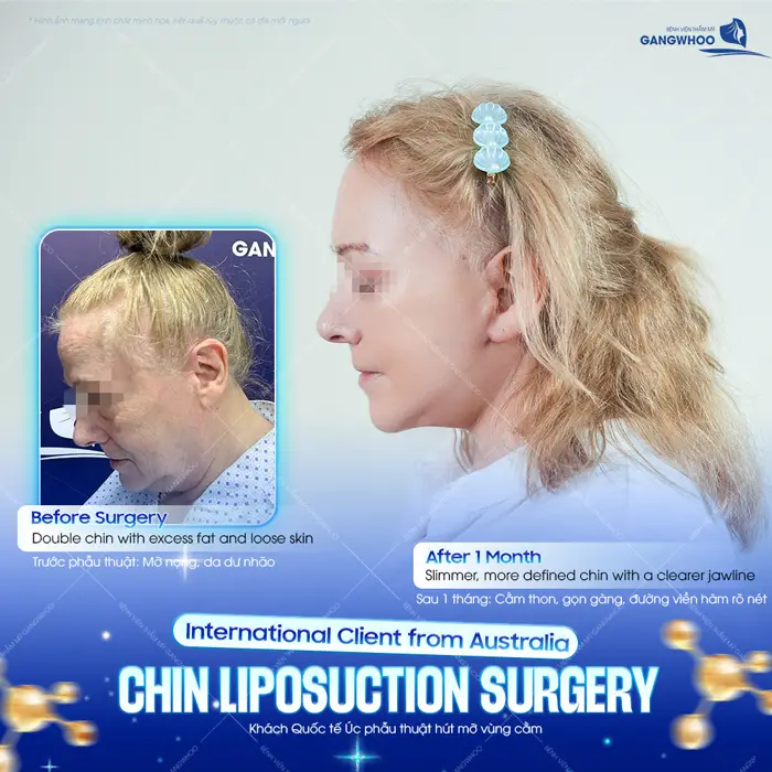 Khách quốc tế phẫu thuật hút mỡ vùng cằm sau 1 tháng đã thấy sự cải thiệ với đường nét thon gọn, mềm mại thấy rõ