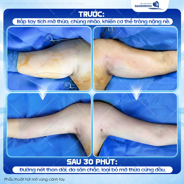 Kết quả sau 30 phút phẫu thuật hút mỡ vùng cánh tay tự tin khoe đôi tay thon đẹp, săn chắc và đầy cuốn hút