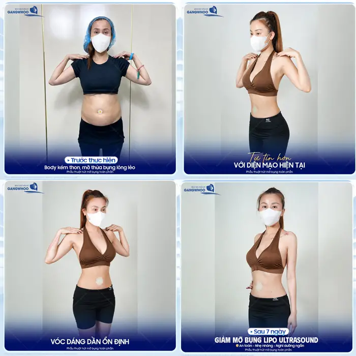 Sau 7 ngày giảm mỡ Lipo ULtrasound vóc dáng dần ổn định tự tin hơn với diện mạo mới