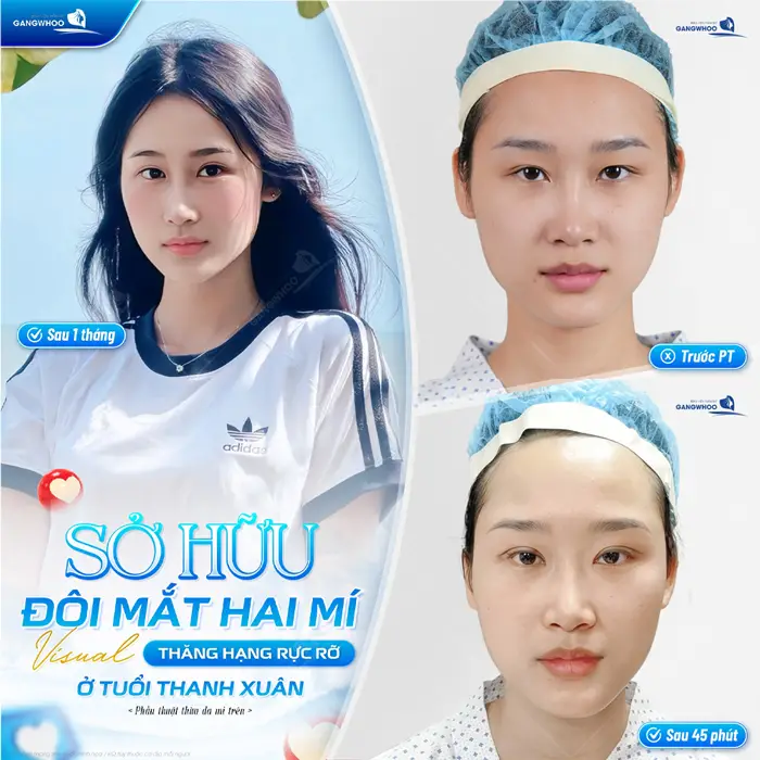 Sở hữu đôi mắt 2 mí đẹp chuẩn visual ở tuổi thanh xuân sau 45 phút nhan sắc đã có điểm nhấn và xinh đẹp hơn thấy rõ