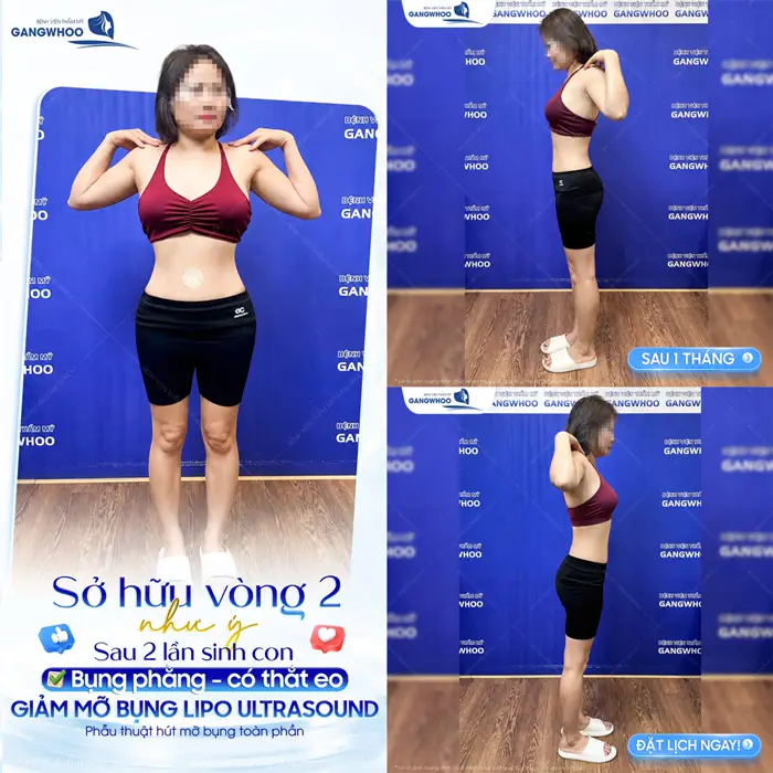 Sở hữu vòng 2 đẹp như ý sau 2 lần sinh con bụng phẳng, eo thon nhờ giảm mỡ bụng công nghệ Lipo Ultrasound