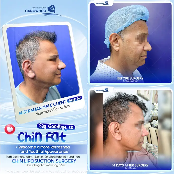 Hút Mỡ Nọng Cằm Có Nguy Hiểm Không? Bác Sĩ Giải Đáp 6 Tạm biệt nọng cằm đón nhân diện mạo trẻ trung hơn sau phẫu thuật hút mỡ cằm