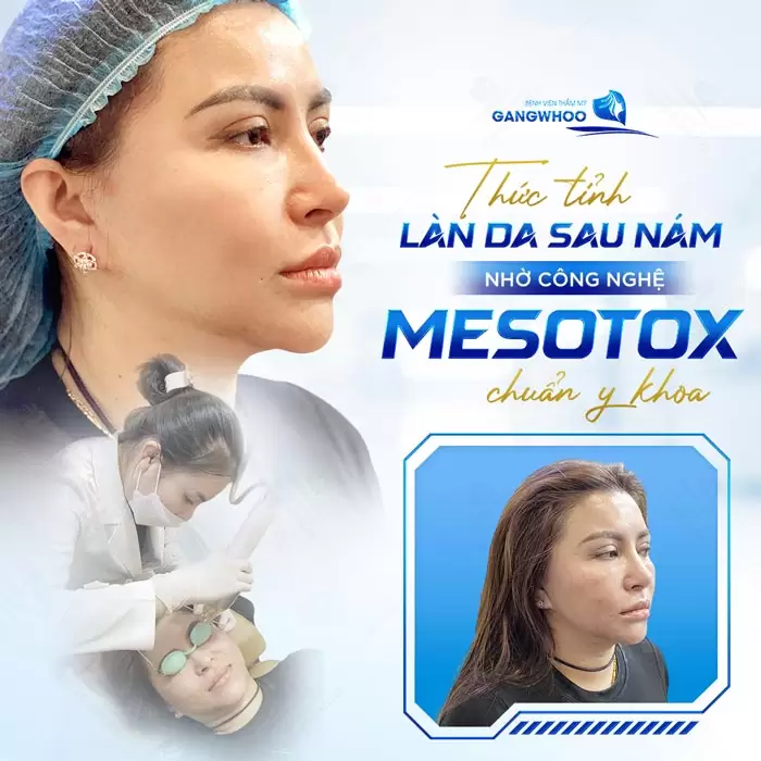 Điều Trị Nám Mesotox - Công Nghệ Đánh Bay Nám Hàn Quốc 2 Tạm biệt làn da sạm nám nhờ công nghệ Mesotox chuẩn y khoa