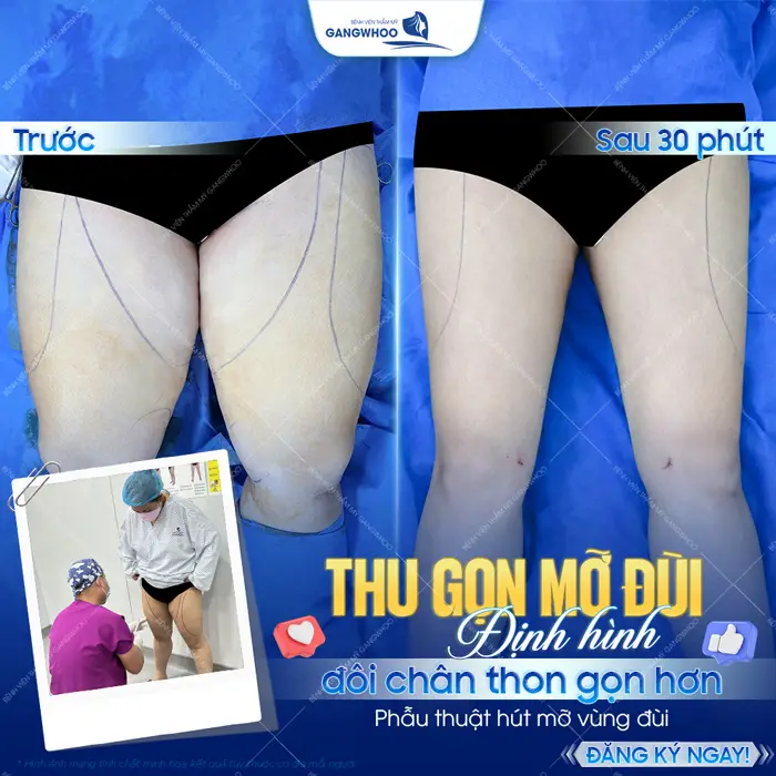 Thu gọn mỡ đùi định hình đôi chân dài thon gọn đẹp xuất sắc sau 30 phút thực hiện