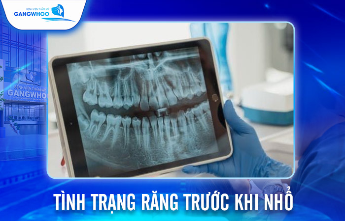 Nhổ Răng Khôn Bao Lâu Thì Lành? Cách Chăm Sóc Nhanh Lành 3 Nhổ Răng Khôn Bao Lâu Thì Lành