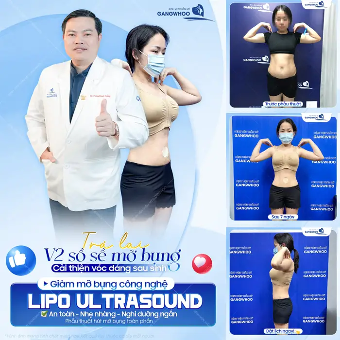 Trả lại vòng 2 sồ sề mỡ bụng cải thiện vóc dáng sau sinh với công nghệ giảm mỡ Lipo Ultrasound hiện đại 