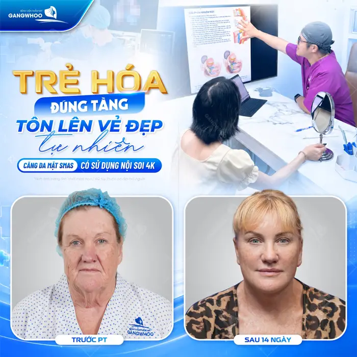 Trẻ hóa đúng tầng toeen lên vẻ đẹp tự nhiên sau căng da mặt Smas có sử dụng nội soi 4K