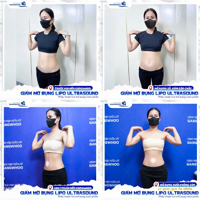 Sau 7 ngày giảm mỡ bụng ứng dụng công nghệ Lipo Ultrasound eo thon, bụng phẳng sắc vóc đẹp chuẩn tỷ lệ