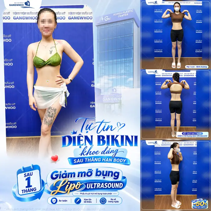 Hút Mỡ Bụng Kiêng Ăn Gì Để Nhanh Chóng Hồi Phục 1 Tự tin diện bikini khoe dáng thăng hạng sau giảm mỡ công nghệ Lipo Ultrasound thành công