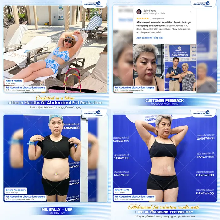Sau 6 tháng giảm mỡ bụng khách hàng đến từ Úc tự tin diện bikini tự tin thả dáng 
