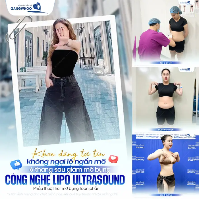 Khoe dáng tự tin không lộ ngấn mỡ sau 6 tháng giảm mỡ bụng công nghệ Lipo Ultrasound