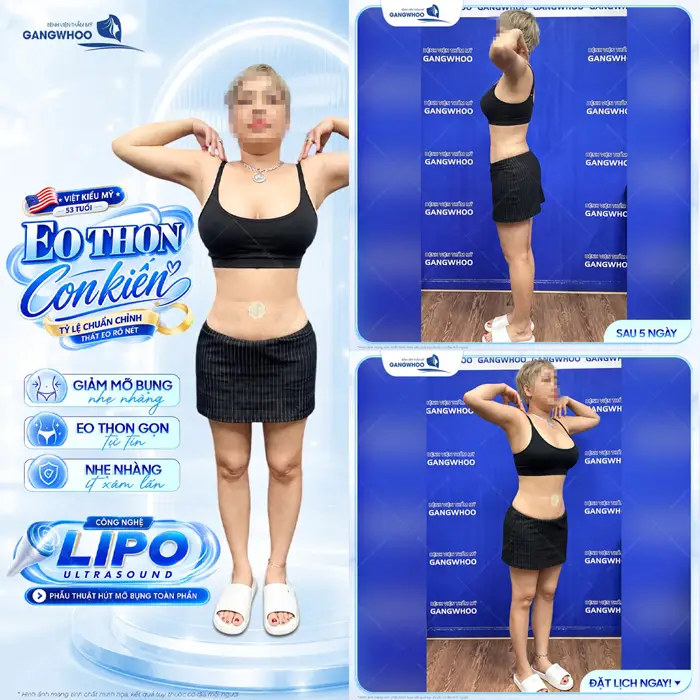 Việt Kiều Mỹ tự tin khoe eo thon, bụng phẳng đẹp xuất sắc sau hút mỡ bụng ứng dụng công nghệ Lipo Ultrasound