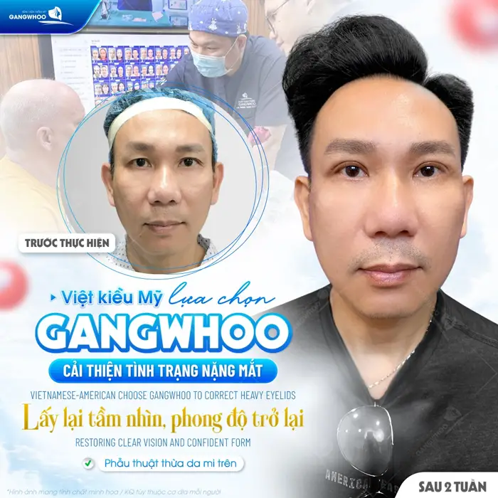 Việt Kiều Mỹ lựa chọn Gangwhoo cải thiện tình trạng nặng mắt lấy lại tầm nhìn phong độ đẹp trở lại