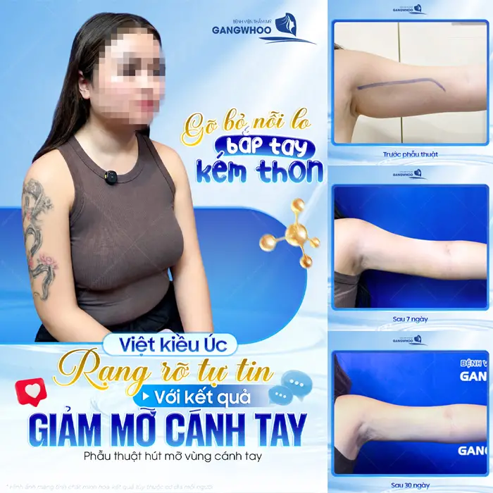 Gỡ bỏ nỗi lo bắp tay kém thon của Việt Kiều Úc cô nàng tự tin khoe đôi tay thon gọn sau giảm mỡ cánh tay