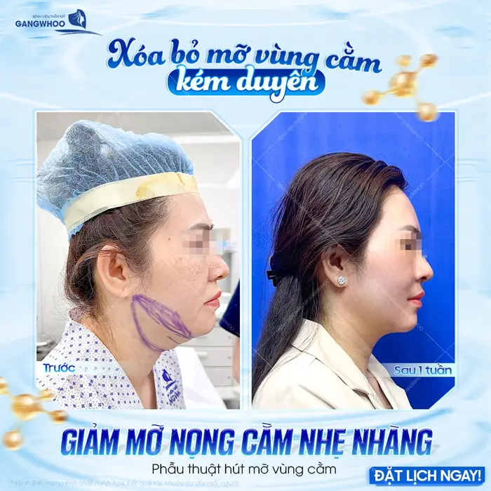 Xóa bỏ mỡ vùng cằm kém duyên giảm mỡ cằm nhẹ nhàng phẫu thuật hút mỡ vùng cằm thon hơn, gọn hơn 