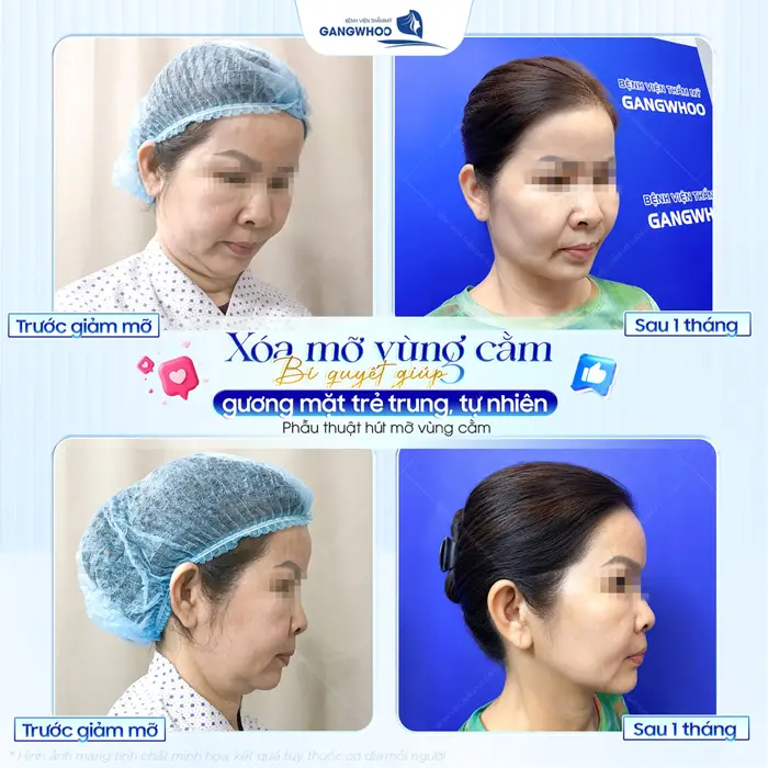 Hút Mỡ Nọng Cằm Có Nguy Hiểm Không? Bác Sĩ Giải Đáp 4 Xóa mỡ nọng cằm gương mặt trẻ trung, tự nhiên và hài hòa hơn sau can thiệp