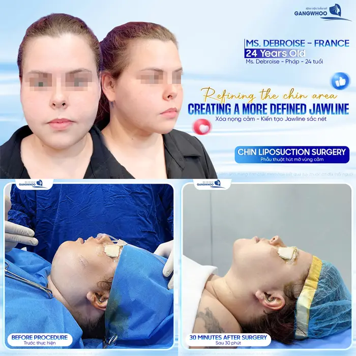 Hút Mỡ Nọng Cằm Ở Đâu Uy Tín? Top 9+ Địa Chỉ Tại TPHCM 12 Xóa nọng cằm kiến tạo viền hàm thon đẹp sau phẫu thuật gương mặt đã hài hòa hơn thấy rõ