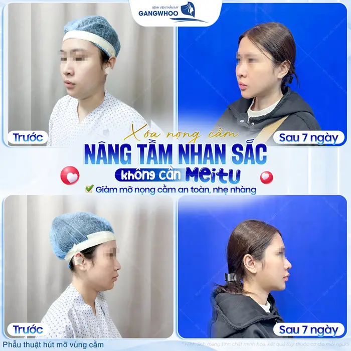 Hút Mỡ Nọng Cằm Có Nguy Hiểm Không? Bác Sĩ Giải Đáp 3 Xóa nọng cằm nâng tầm nhan sắc giảm mỡ nhẹ nhàng và an toàn sau 7 ngày gương mặt đẹp thon gọn