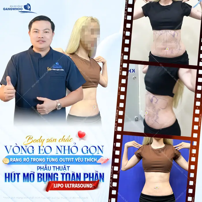 Phẫu thuật hút mỡ bụng toàn phần vòng eo thon gọn tha hồ thả dáng trong từng outfit