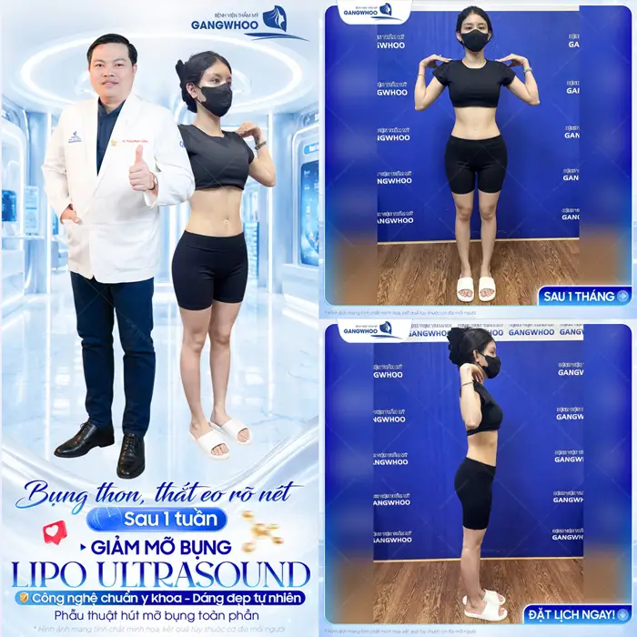 Bụng thon, thắt eo rõ nét sau 1 tuần giảm mỡ bụng công nghệ Lipo Ultrasound bụng phẳng, đẹp thon thả 