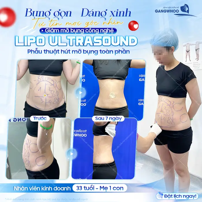 Bụng gọn dáng xinh tự tin cân đẹp mọi khung hình, kết quả sau 7 ngày giảm mỡ bụng bụng công nghệ Lipo Ultrasound 