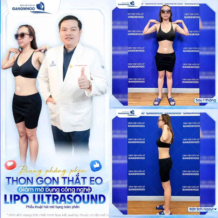 Bụng phẳng phiu thon gọn thắt eo sau giảm mỡ bụng Lipo Ultrasound sau 1 tháng đã hoàn toàn thon thả