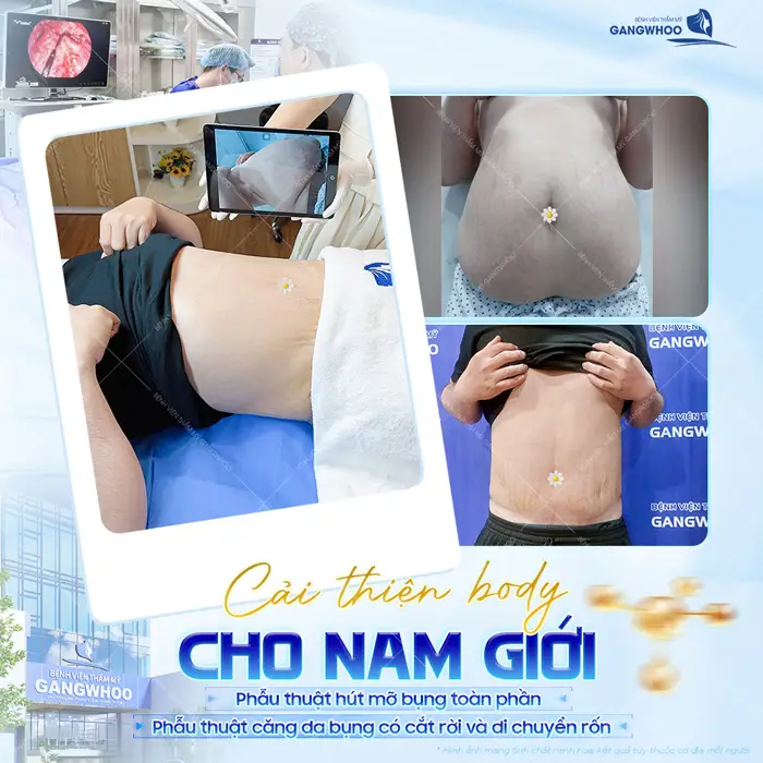 Cải thiện body cho nam giới sau phẫu thuật hút mỡ bụng body đã săn chắc và cải thiện thấy rõ