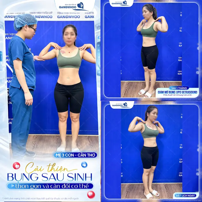 Cải thện bụng mỡ sau sinh với công nghệ Lipo Ultrasound tự tin khoe eo thon bụng gọn sắc vóc đẹp chuẩn