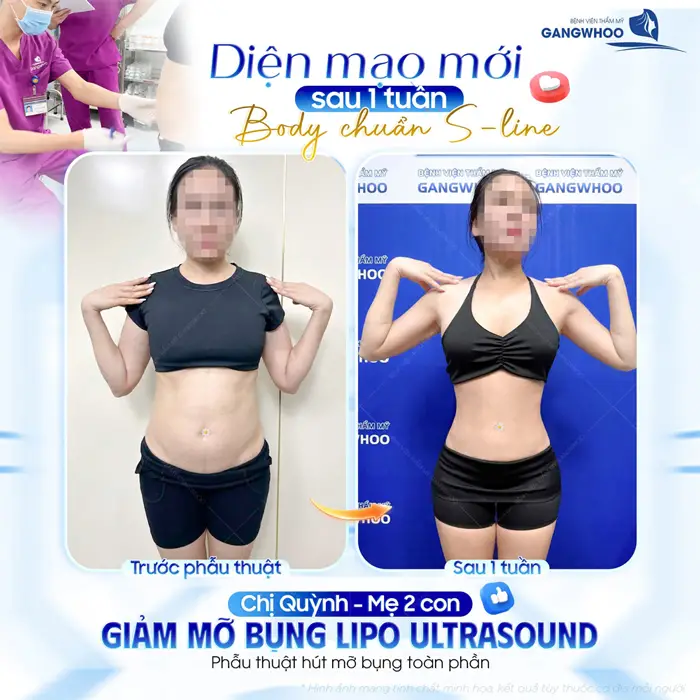 Diện mạo mới sau 1 tuần giảm mỡ bụng Lipo Ultrasound body đẹp chuẩn đường cong chữ S