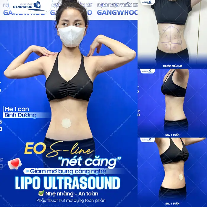 Eo thon gọn đẹp chuẩn S LIne với đường nét phẳng gọn chỉ sau 1 lần giảm mỡ công nghệ Lipo ULtrasound sắc vóc đã đẹp thăng hạng