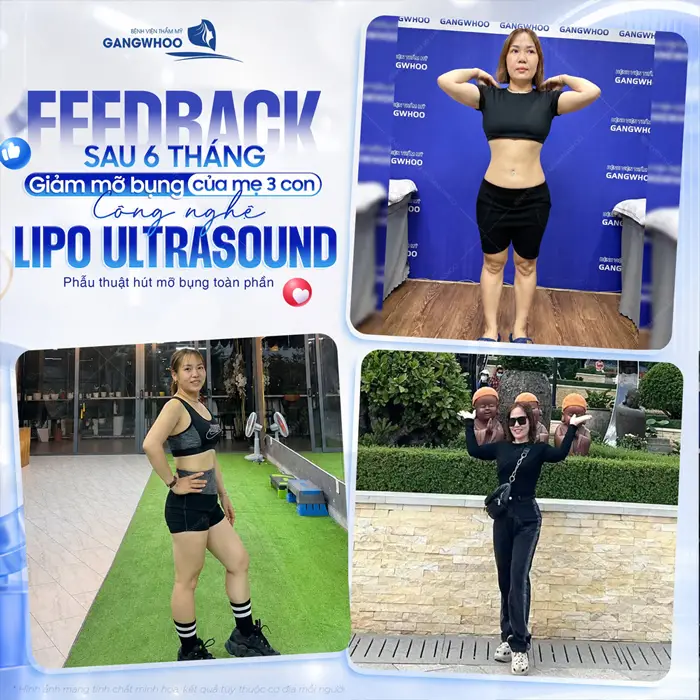 Hút Mỡ Bụng Bao Lâu Thì Tập Thể Dục Được? Bác Sĩ Giải Đáp 1 Feedback au 6 tháng giảm mỡ bụng của mẹ 3 con sau giảm mỡ công nghệ Lipo Ultrasound