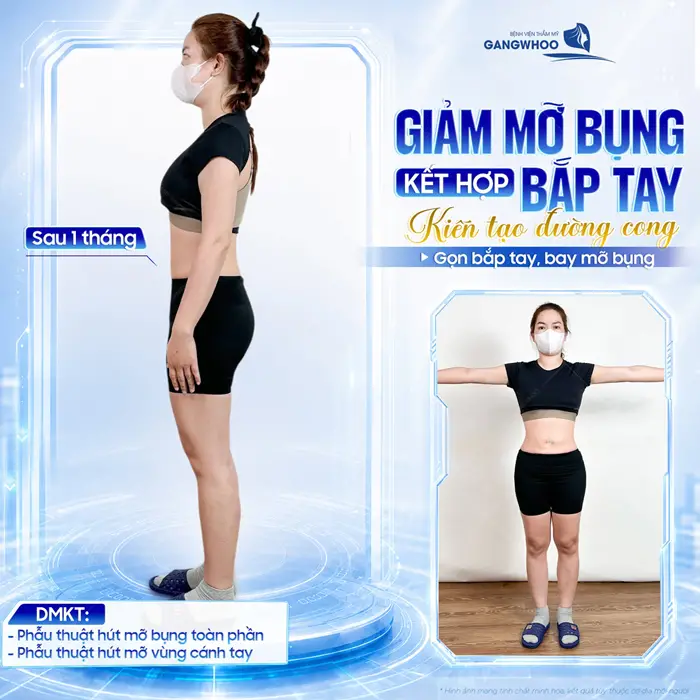 Giảm mỡ bụng kết hợp mớ bắp tay kiến tạo đường cong đẹp xuất sắc với bắp tay gọn, mỡ bụng thon thả