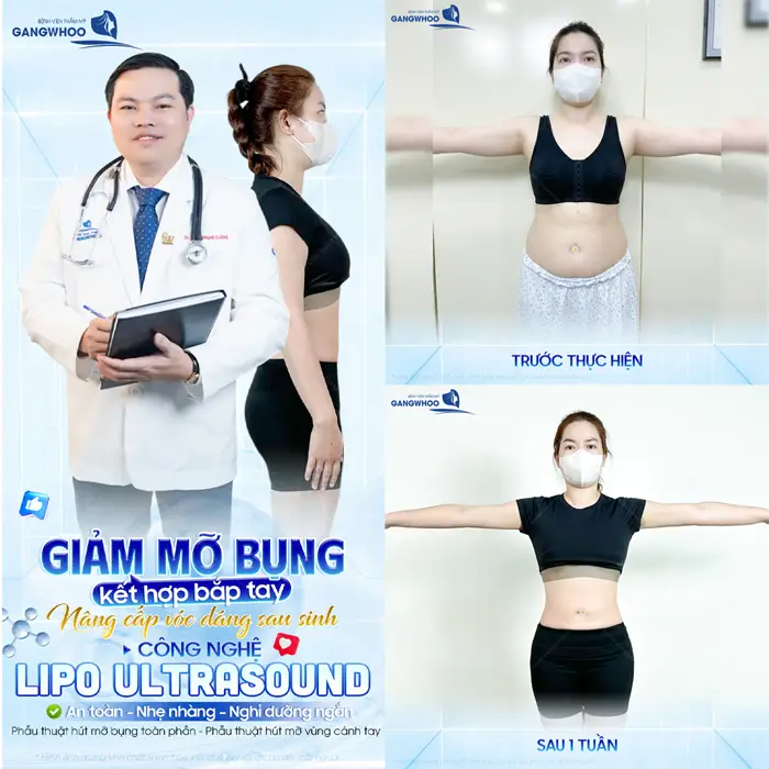Hút Mỡ Bụng Bao Lâu Hồi Phục Hoàn Toàn? Bác Sĩ Giải Đáp 14 Giảm mỡ bụng kết hợp mỡ bắp tay nâng cấp vóc dáng sau sinh với công nghệ Lipo Ultrasound hiện đại