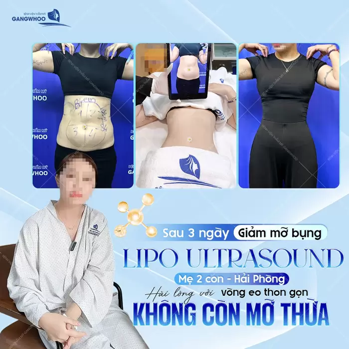 Giảm mỡ bụng công nghệ (Lipo Ultrasound) mẹ bỉm 2 con hài lòng với vòng eo đẹp siêu thực 