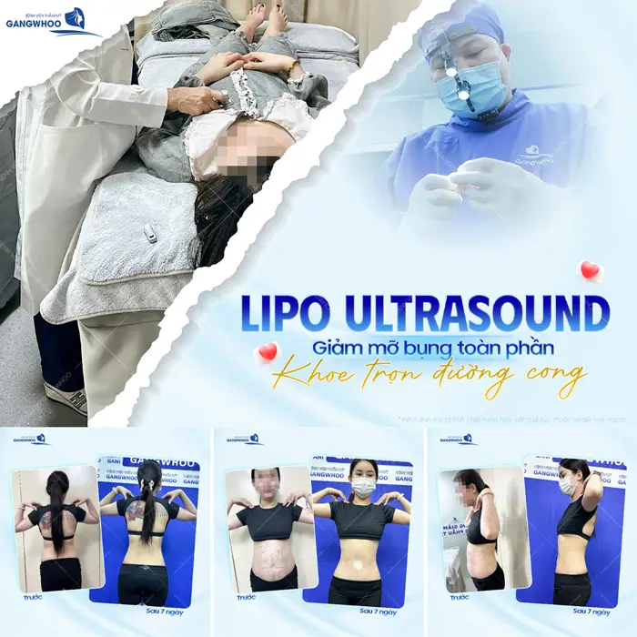 Giảm mỡ bụng toàn phần công nghệ (Lipo Ultrasound) khoe trọn đường cong hoàn hảo