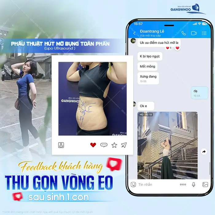 Thon gọn vòng eo sau sinh chỉ 1 lần phẫu thuật hút mỡ bụng toàn phần body đã hoàn toàn thay đổi