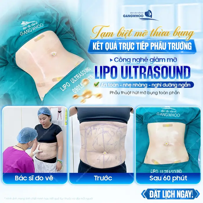 Tạm biệt mỡ thừa bụng kết quả trực tiếp phẫu trường với công nghệ giảm mỡ Lipo Ultrasound hiện đại