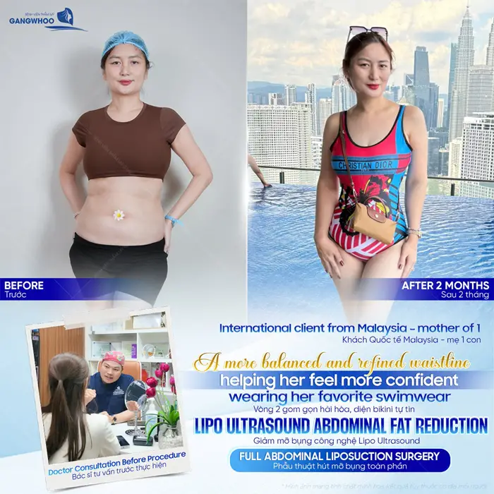 Vòng 2 thon gọn tự tin diện bikini đẹp chuẩn hoàn hảo sau 1 lần giảm mỡ bụng công nghệ Lipo Ultrasound