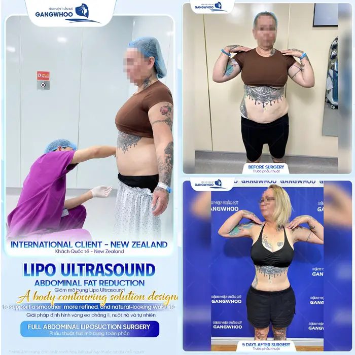 Hút Mỡ Bụng Bao Lâu Hồi Phục Hoàn Toàn? Bác Sĩ Giải Đáp 3 Bụng thon đẹp gọn, body đẹp cuốn hút sau giảm mỡ bụng công nghệ Lipo Ultrasound hiện đại