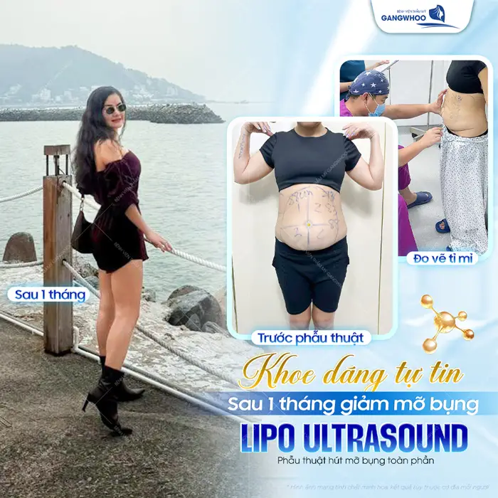 Sau 1 tháng thực hiện khách hàng hài lòng về kết quả giảm mỡ bụng Lipo Ultrasound vì màn lột xác vượt ngoài mong đợi