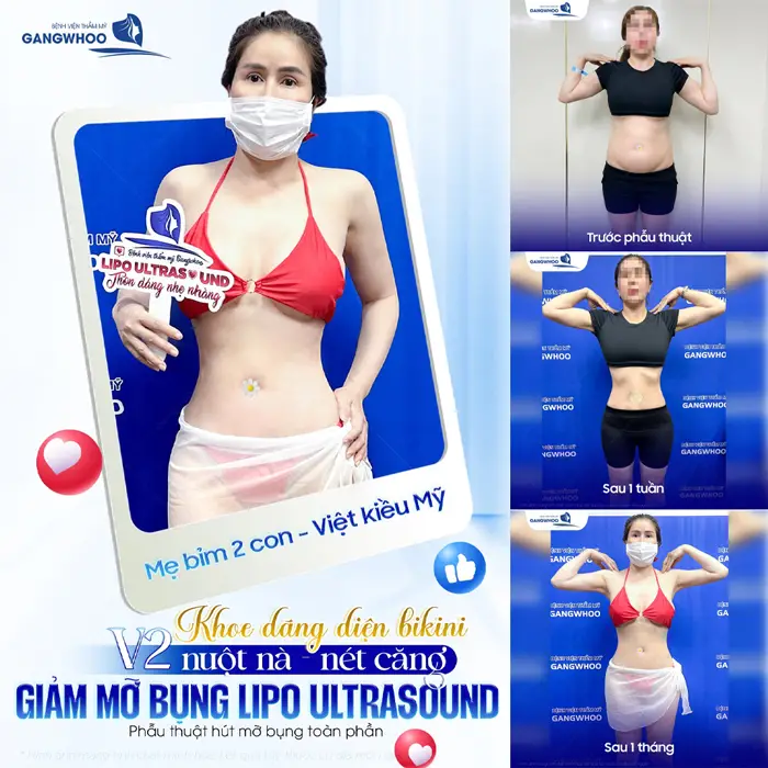 Khoe dáng diện Bikini vòng 2 nuột nà đẹp căng nét với công nghệ giảm mỡ bụng Lipo Ultrasound