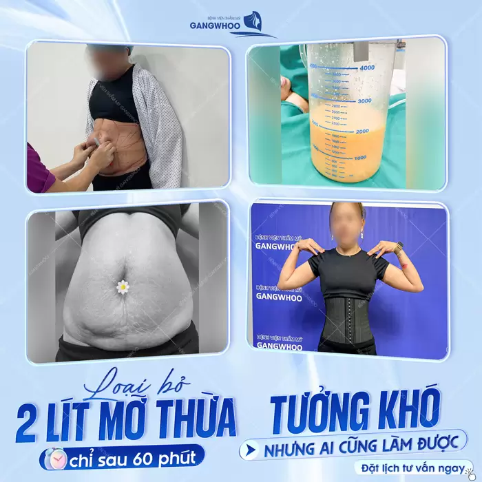 Hút Mỡ Toàn Thân Có Nguy Hiểm Không? 11 Loại bỏ mỡ thừa tưởng khó nhưng ai cũng có thể làm được