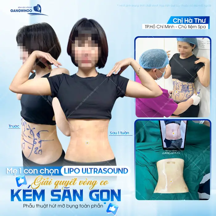 Mẹ 1 con chọn phẫu thuật hút mỡ bụng toàn phần công nghệ Lipo Ultrasound giải quyết vòng eo kém săn gọn hiệu quả 