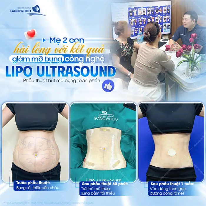 Mẹ 2 con hài lòng với kết quả giảm mỡ bụng công nghệ Lipo Ultrasound eo thon bụng phẳng rõ rệt theo từng ngày