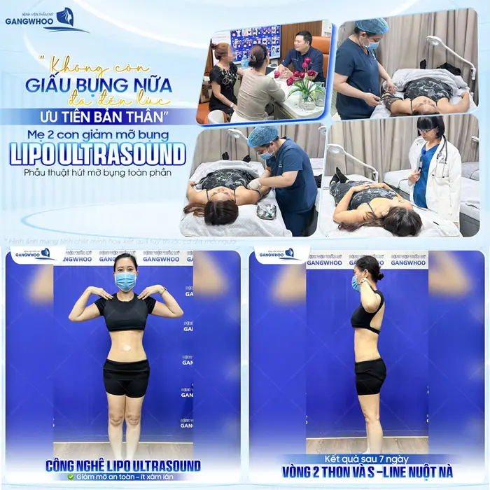 Mẹ 2 con giảm mỡ bụng Lipo Ultrasound sau 7 ngày tự tinhơn với diện mạo không còn khuyết điểm 