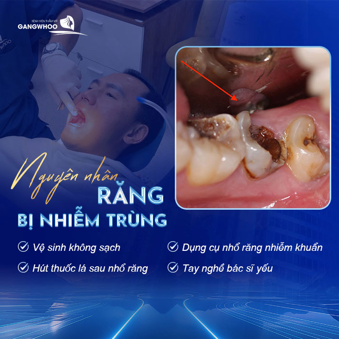 Nhổ Răng Bị Nhiễm Trùng